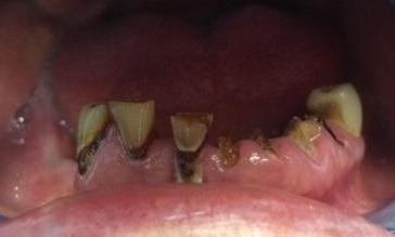 Removal-of-Failing-Teeth-and-Beautiful-Dentures-Before-Image