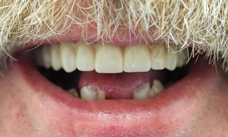 Fixed-Complete-Teeth-with-Dental-Implants-After-Image
