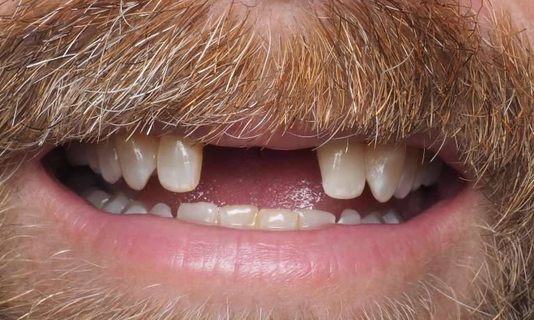 Dental-Implants-for-Both-Front-Teeth-Before-Image