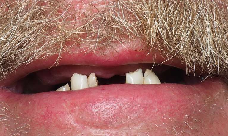 Fixed-Complete-Teeth-with-Dental-Implants-Before-Image